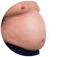 Obezita a gynekomastia vplyvom andropauzy