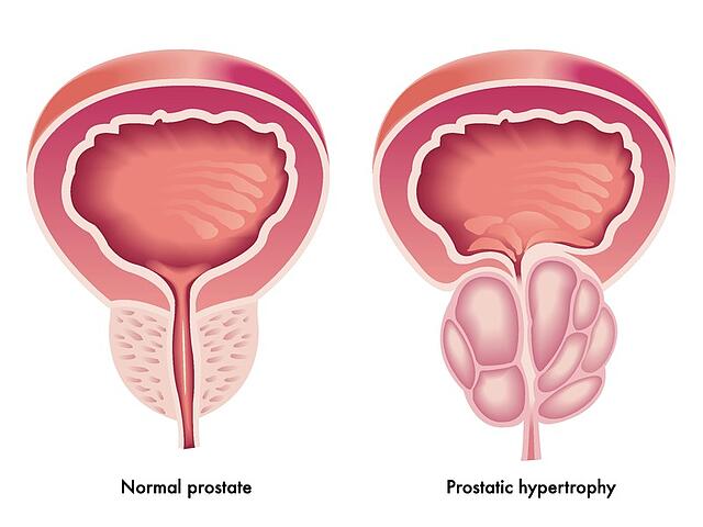 Jak vypada Zvetsena prostata?